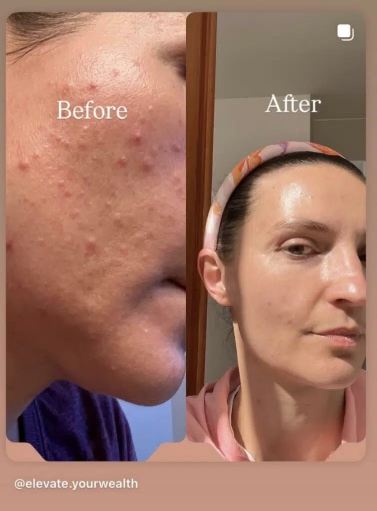 Close-up comparison of a person’s skin before and after using Olive Rose, showing reduced redness and smoother texture.
